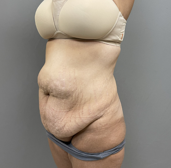 Tummy Tuck