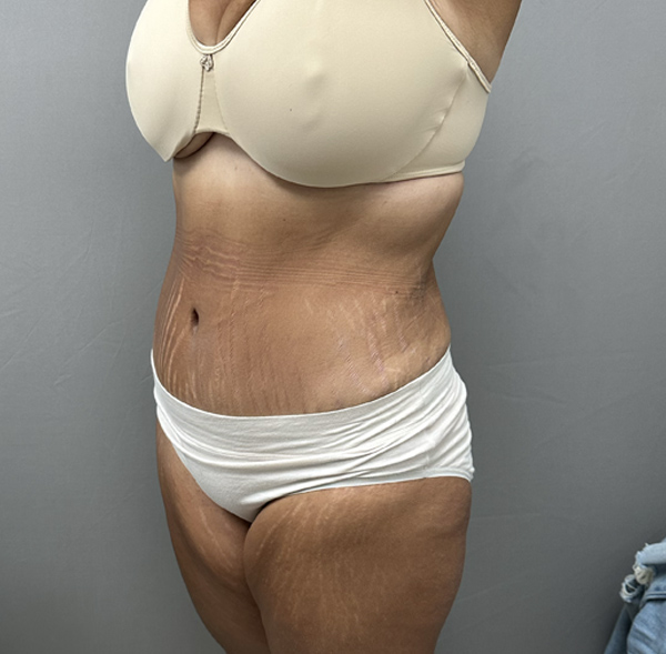 Tummy Tuck