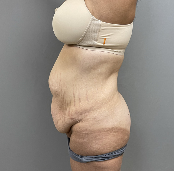 Tummy Tuck