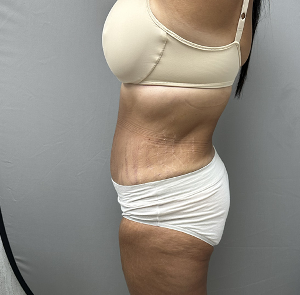 Tummy Tuck