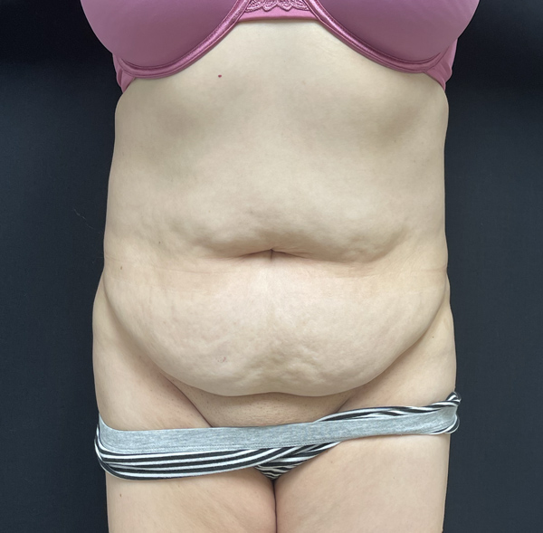 Tummy Tuck