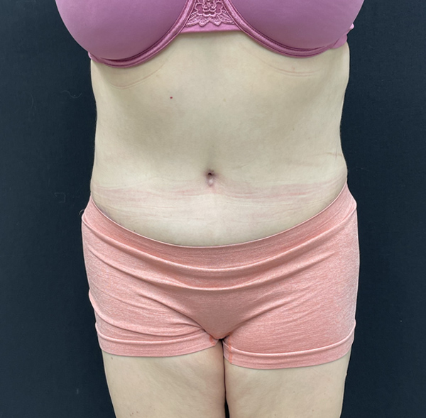 Tummy Tuck