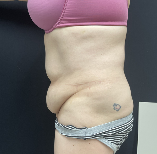 Tummy Tuck