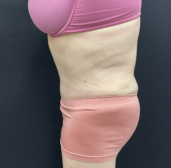 Tummy Tuck