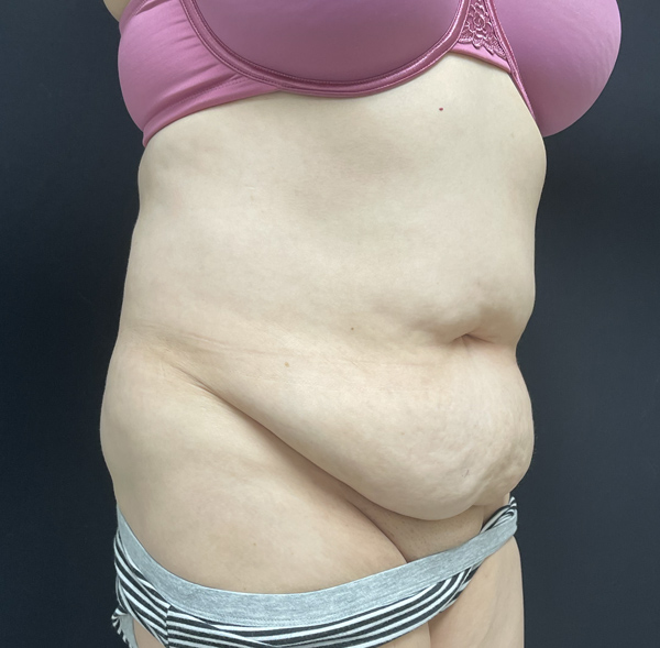 Tummy Tuck