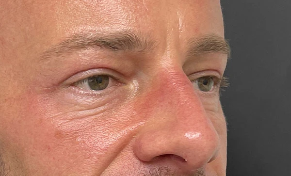 Blepharoplasty