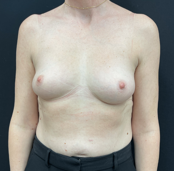 Breast Augmentation