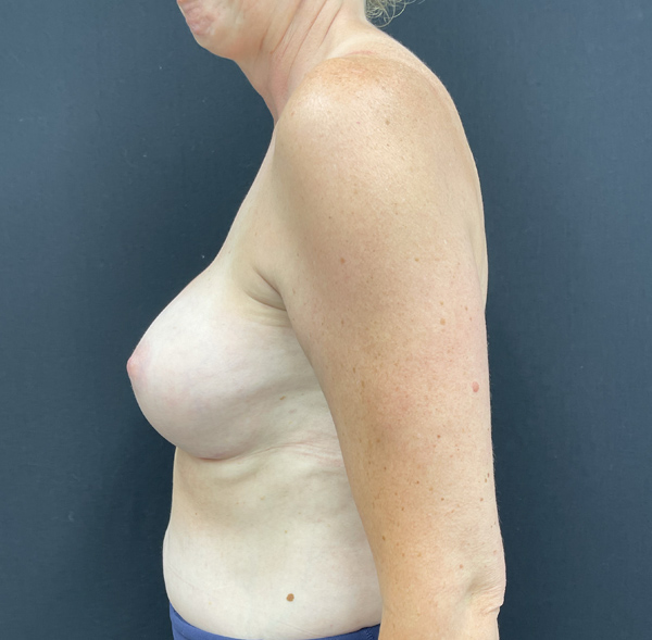 Breast Augmentation