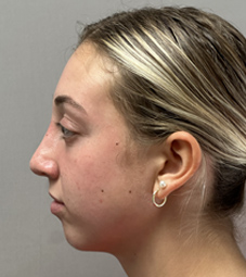 Rhinoplasty