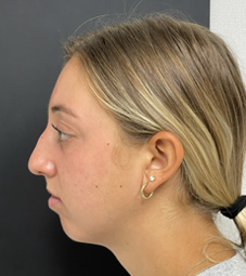 Rhinoplasty