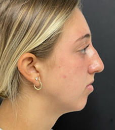 Rhinoplasty