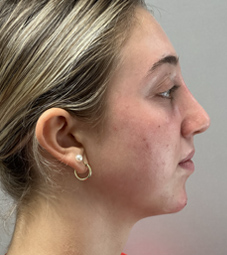 Rhinoplasty