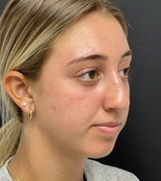 Rhinoplasty