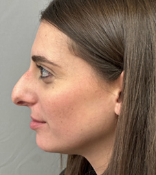 Rhinoplasty