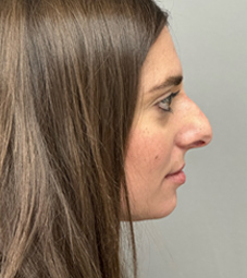 Rhinoplasty