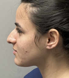 Rhinoplasty