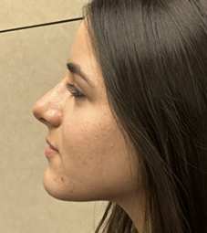 Rhinoplasty