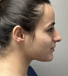 Rhinoplasty