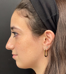 Rhinoplasty