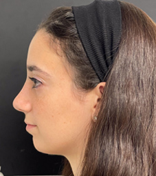 Rhinoplasty