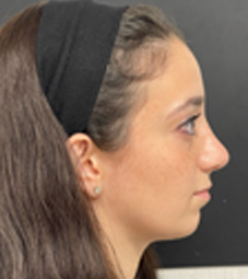 Rhinoplasty