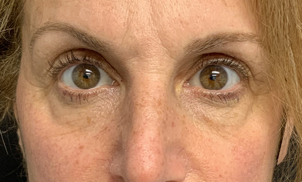 Blepharoplasty