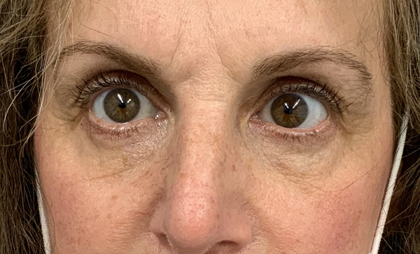 Blepharoplasty