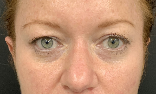 Blepharoplasty