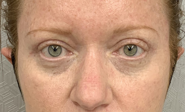 Blepharoplasty