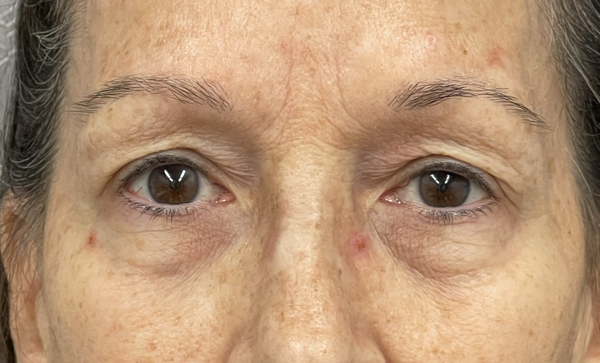 Blepharoplasty