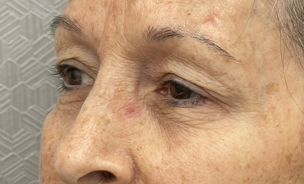 Blepharoplasty