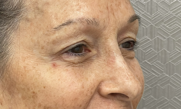 Blepharoplasty