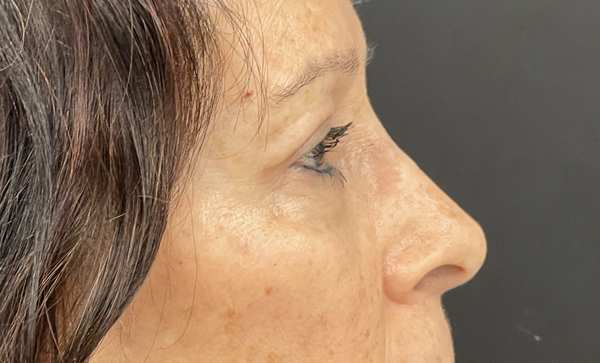 Blepharoplasty