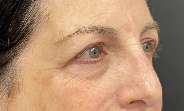 Blepharoplasty