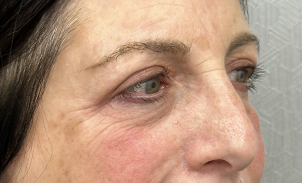 Blepharoplasty