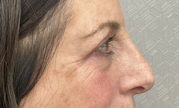 Blepharoplasty