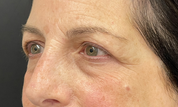 Blepharoplasty