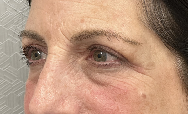 Blepharoplasty