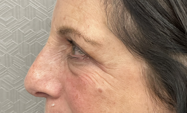 Blepharoplasty