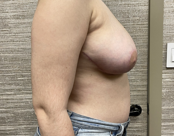 Breast Reduction