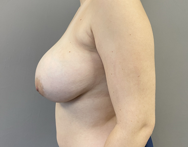 Breast Reduction