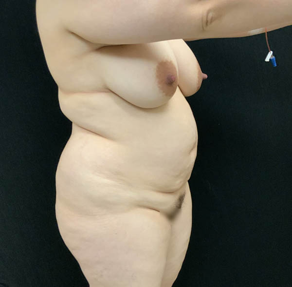 Tummy Tuck