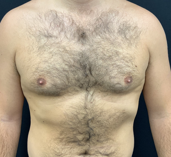 Gynecomastia