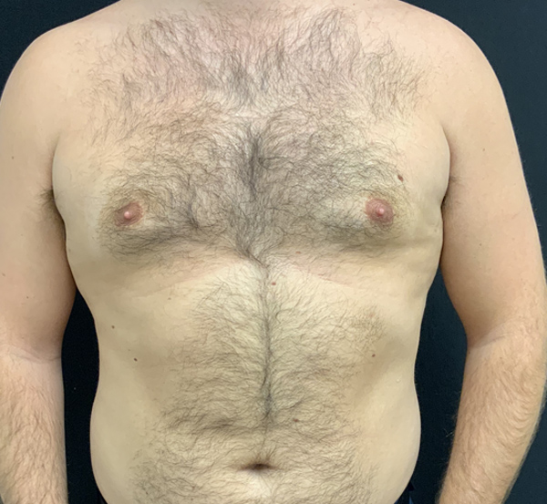 Gynecomastia