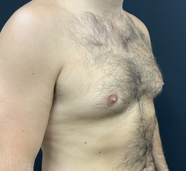 Gynecomastia