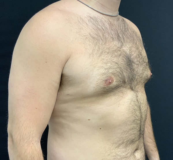 Gynecomastia