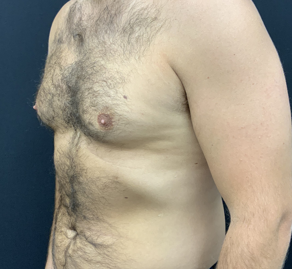 Gynecomastia