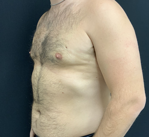 Gynecomastia