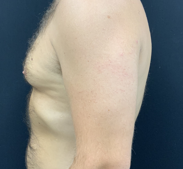 Gynecomastia