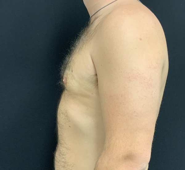 Gynecomastia